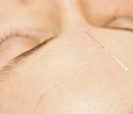 Dry Needling